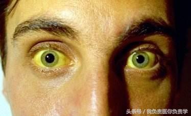 出現這4個症狀趕緊去醫院別猶豫,胰腺癌可能已經在路上