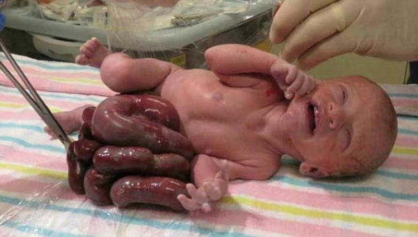 醫生建議媽媽墮胎但她不聽，堅持生下「內藏在體外的寶寶」8個月後…