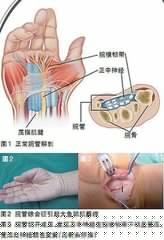 自救「媽媽手」免動刀!【四大解僵救星】照著做,「肌腱」自己軟回去