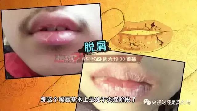 嘴唇脫皮、皸裂一定別輕視!或是疾病信號
