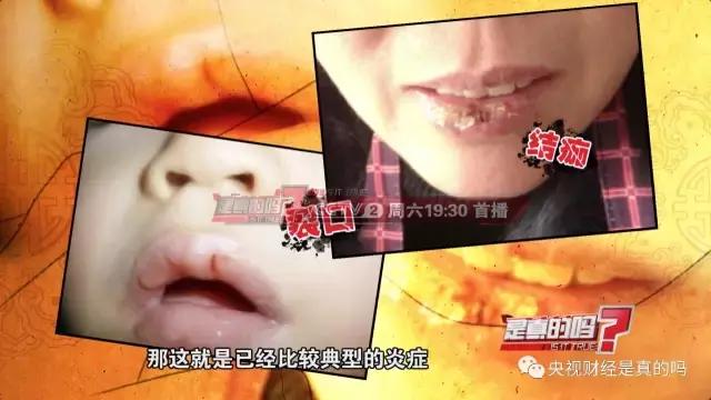 嘴唇脫皮、皸裂一定別輕視!或是疾病信號