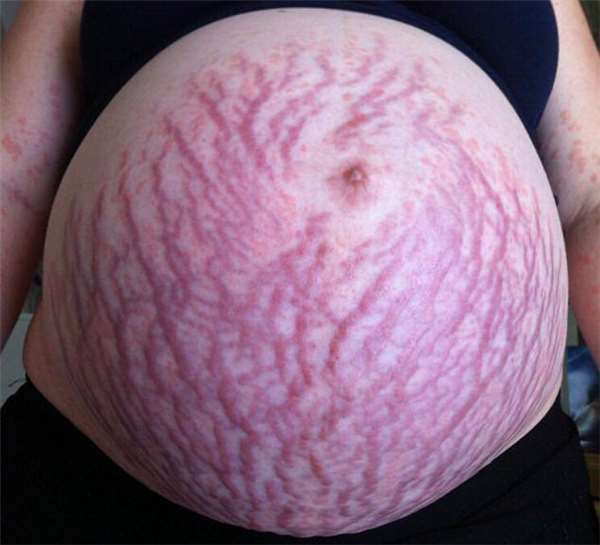一觉醒来的孕妇发觉隆起的肚子布满密集的「妊娠纹」