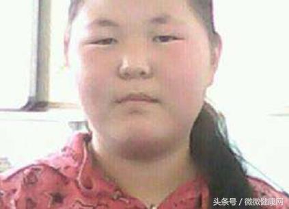 喝杯水都會胖的人,1種常見花的葉子颳走油脂,2周能見效果