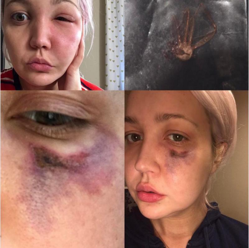 她醒來時發現自己的臉上少了一塊肉…再看看右手時直接嚇瘋了!