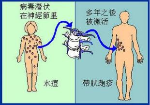 帶狀皰疹患者發病徵兆有哪些?單純皰疹病毒1型和2型