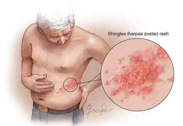 帶狀皰疹患者發病徵兆有哪些?單純皰疹病毒1型和2型