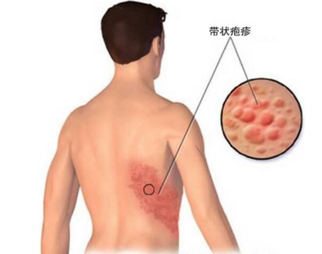 帶狀皰疹患者發病徵兆有哪些?單純皰疹病毒1型和2型