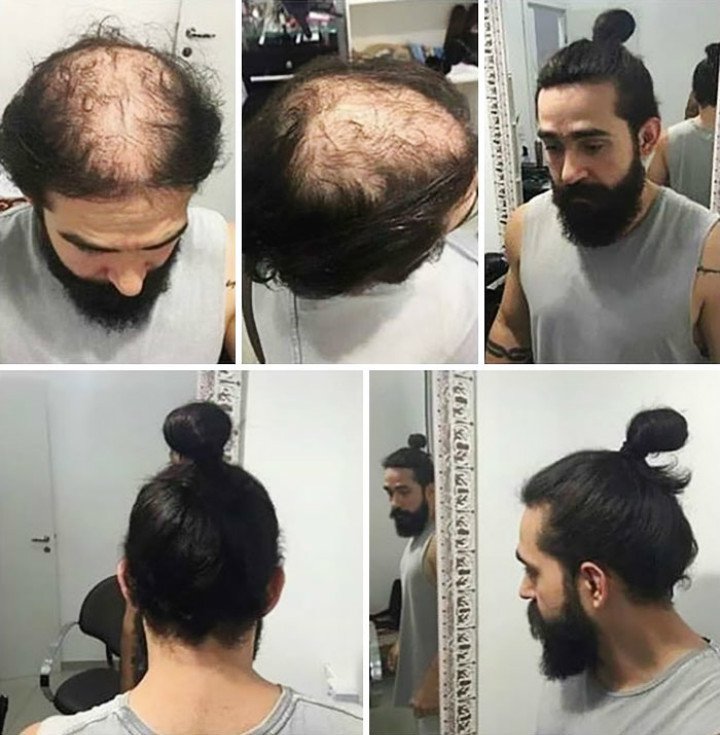 現在只需要一根「橡皮筋」就能讓髮量少的男人變身「超級型男」!