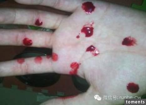 2歲幼兒因流鼻血昏了過去,心急的媽媽趕緊把孩子送到醫院,結果醫生卻宣告不治!當媽媽抓著醫生問為什麼,聽完解釋的她默默心冷