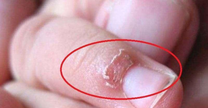 你的手指常常脫皮「倒刺指」嗎?千萬不要直接把皮撕下來,你應該要這樣做才對!