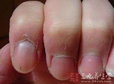 你的手指常常脫皮「倒刺指」嗎?千萬不要直接把皮撕下來,你應該要這樣做才對!