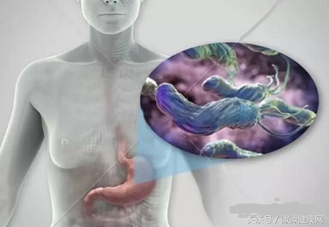 感染幽門螺旋桿菌,到發胃病患胃癌,需要多久?