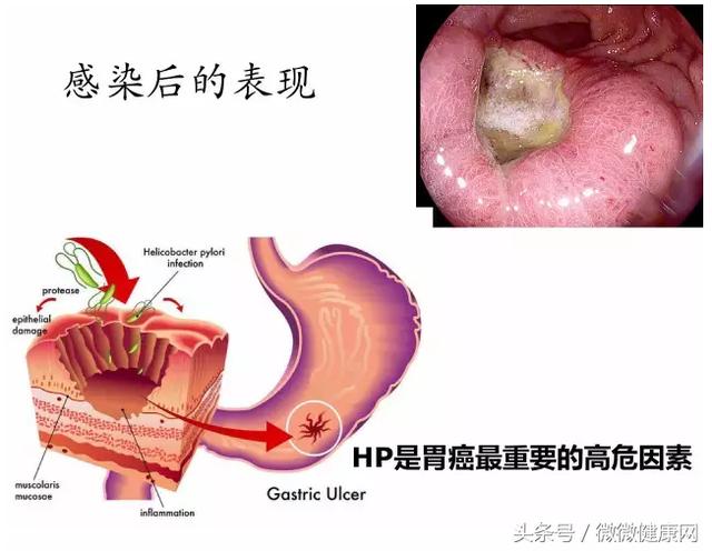 感染幽門螺旋桿菌,到發胃病患胃癌,需要多久?