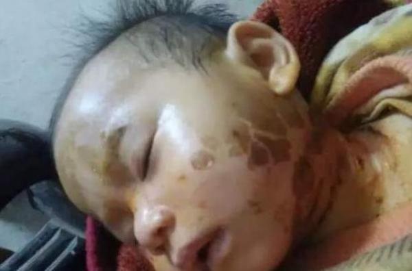 1歲小孩臉部燙傷80%,只用了「這個東西」!臉竟然完全好了!醫生都不知道的,一定要分享!