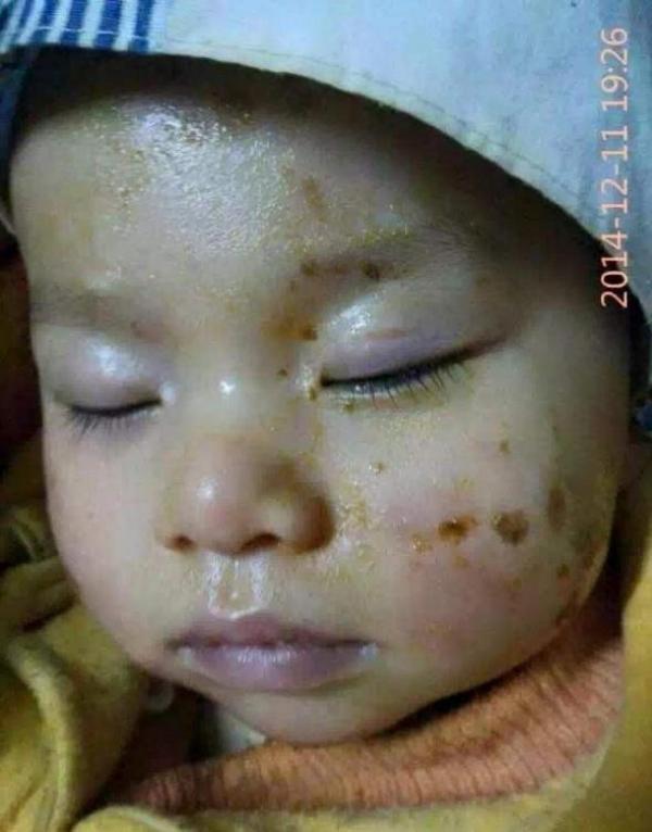 1歲小孩臉部燙傷80%,只用了「這個東西」!臉竟然完全好了!醫生都不知道的,一定要分享!