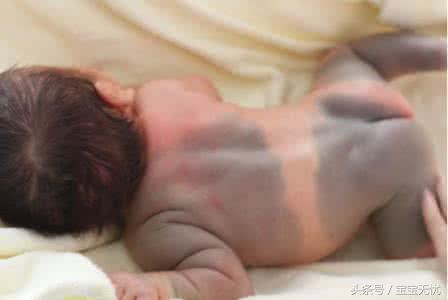 胎記是閻王爺蓋的印嗎? 還是來聽聽這個美麗的傳說吧