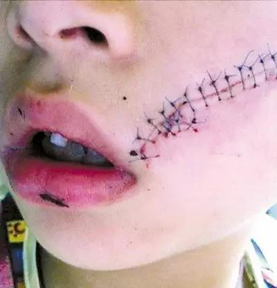 男童「臉部被炸傷」縫了38針!這東西放冰箱變「炸彈」!但是你卻老是這麼做…馬上停止!