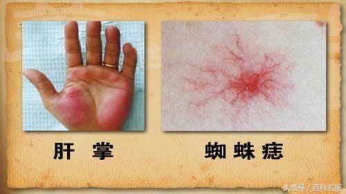 手掌泄露了你的身體秘密:手掌出現「這8種癥狀」或是大病的徵兆,你有嗎?