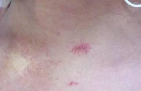 身上長這「2種痣」,要小心「肝臟病變」,最好去醫院檢查一下!