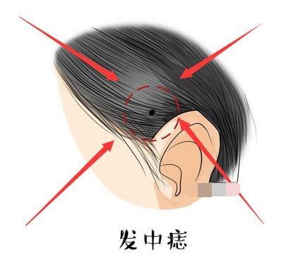 長在「這些地方」的黑痣最招財,有一顆財運亨通,身家千萬!