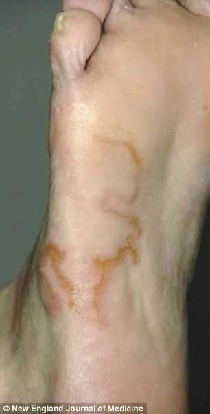 他發現腳上有「紅色的痕跡」以為是靜脈曲張，一個月後發現血管會移動，趕緊就醫！