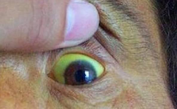 注意!4個信號一出現,警惕脂肪肝「惡化」,小心「肝硬化」!教你三招保護肝臟健康!