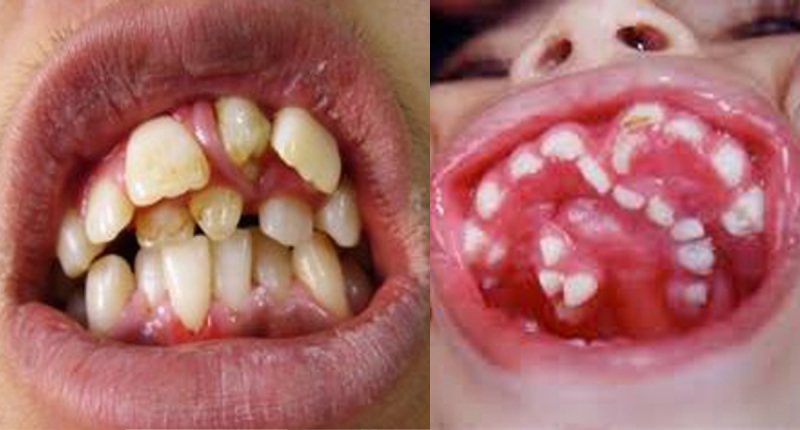 警告!一旦嘴巴里出现这「8种牙齿」一定要拔掉!一刻都不得久留!