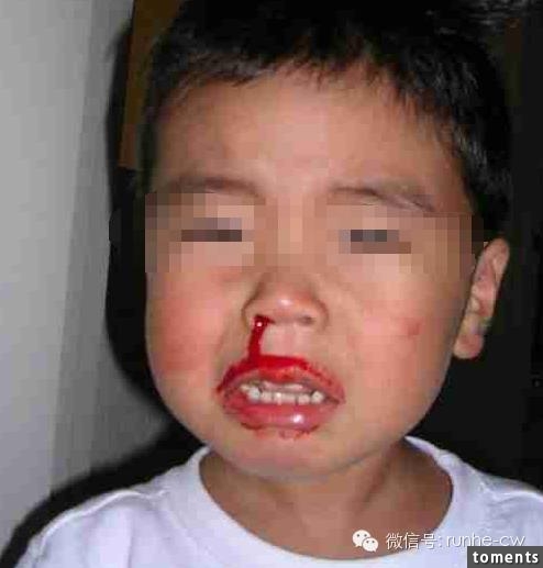 2歲男童因流鼻血窒息喪命，90%的人都在用錯誤的止鼻血方法！