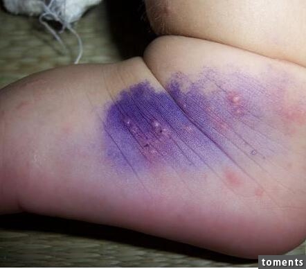 5歲女孩遭蚊子叮咬82天昏迷不醒(圖) 我必須告訴大家蚊蟲叮咬的恐怖！