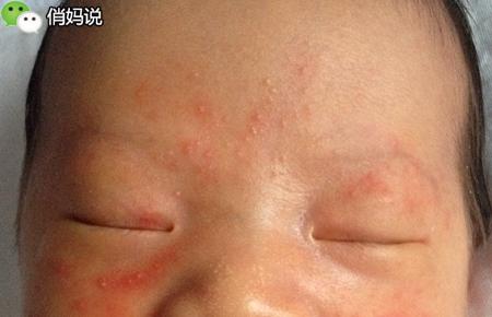 媽媽必看！寶寶皮膚出現這些問題都不是濕疹，千萬別自作聰明！