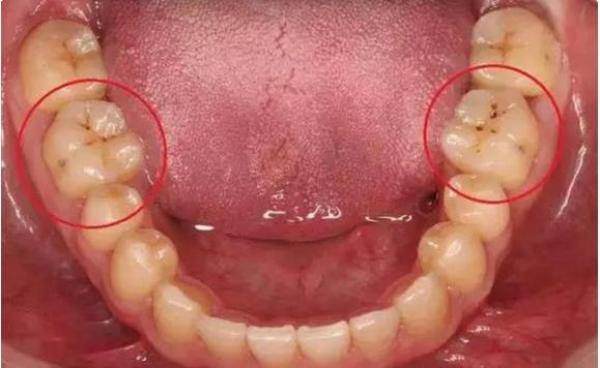 答:牙齿上的黑斑的去除方法:牙齿上的黑斑一般是由龋齿,酸腐蚀,各种