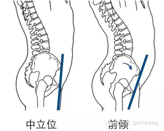 你的翹臀不一定是真的，還可能是骨盆前傾