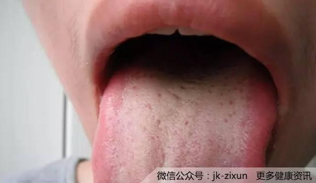 舌苔厚黃? ! 咋回事