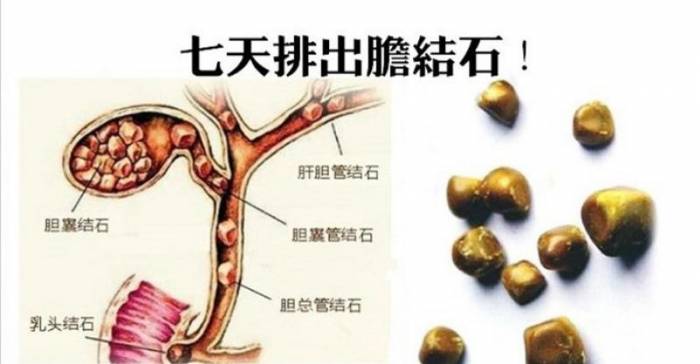 体内肝胆结石自己动手清理,七天排出胆结石(供参考)
