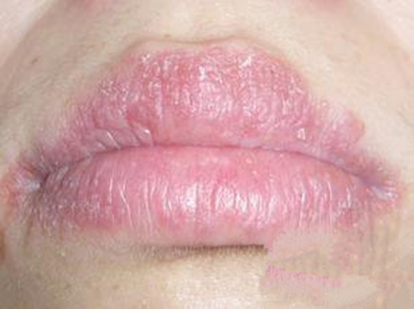 西医认为导致唇炎的原因比较复杂,一般和遗传,感染,过敏,维生素b2