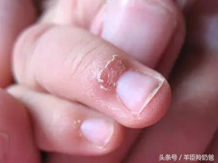亂給寶寶剪指甲後果很嚴重，10個媽媽9個都剪錯了！