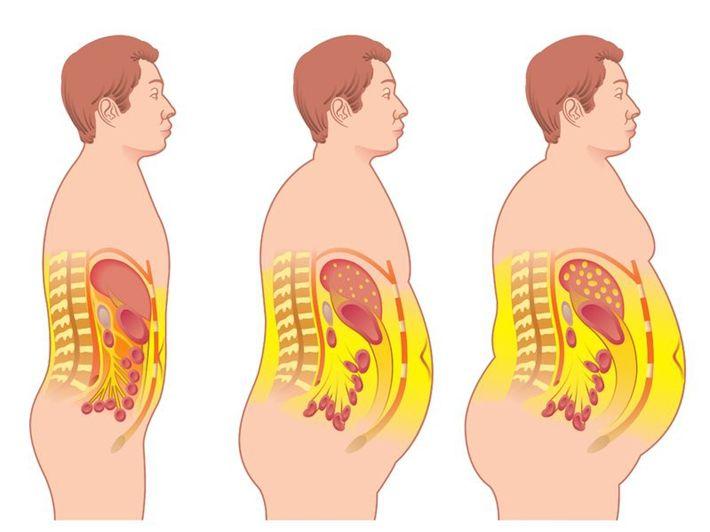 「肚子大」你以為是「發福」嗎？ 別傻了，不是福！ 腰粗的人會被5種病慢性病纏身！