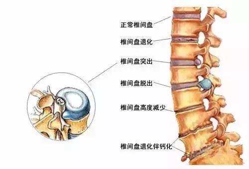 腰椎間盤突出患者千萬不能這樣按摩不當姿勢可致癱瘓