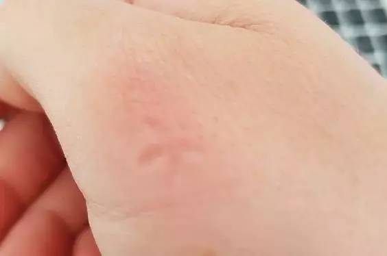 被蚊子咬後皮膚越抓越癢，教你個止癢絕招，只需10秒鐘止癢不留印痕