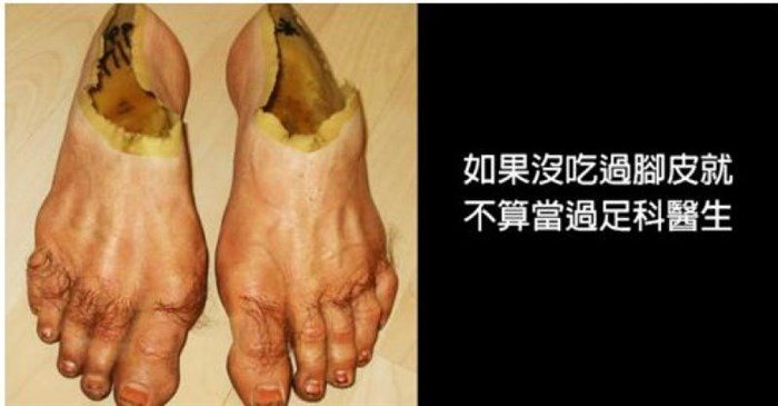 腳指甲會變得越來越粗！23個「足科醫生沒有告訴過你的內心話」！