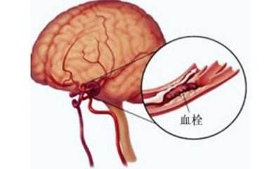 腦血管是否栓塞，看身體的4個地方就知道，5招疏通血管