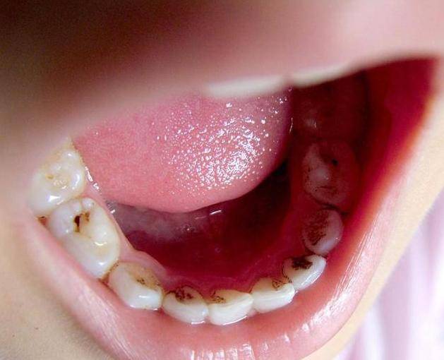 对牙齿有伤害吗?