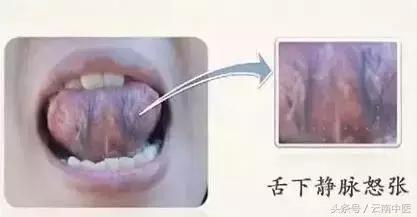 腦梗塞、冠心病、肝硬化……都與它有關！一食療小方輕鬆化解~