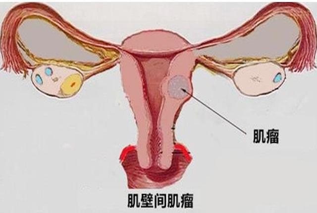 子宮肌瘤是「吃」出來疾病,4種食物能不碰就不碰, 女人為自己收藏
