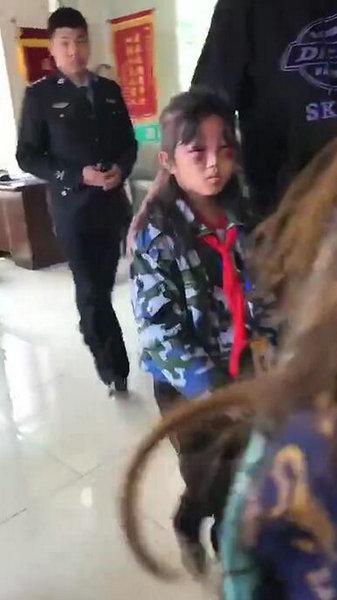 女孩遭繼母打罵成「熊貓眼」 警方稱女孩已被送醫救治，打人者正在接受審訊