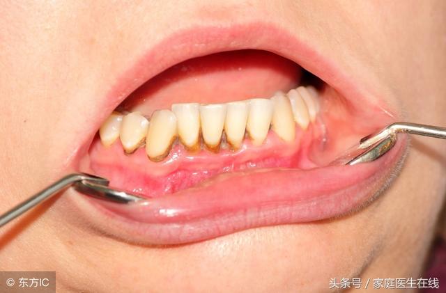 口腔裡有牙結石，對人體有哪些危害？主要有3個