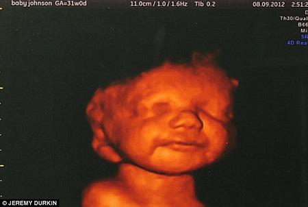 26岁准妈妈怀孕20周时,医生却说胎儿严重残障,但她坚持生下孩子!