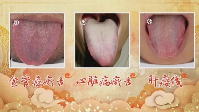 瘀舌是食管癌的高危舌象，這兩種舌象是瘀舌的特性！