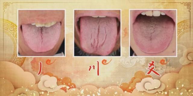 瘀舌是食管癌的高危舌象，這兩種舌象是瘀舌的特性！