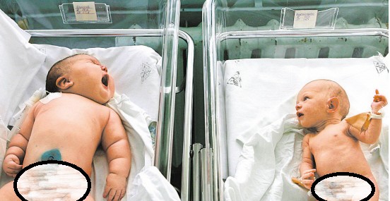 澳洲300公斤孕婦臨盆竟「出動直升機」！沒想到嬰兒出生後的模樣，連護士都嚇一大跳了！